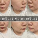 아크리스 | 지성피부 여드름폼클렌징 추천 바하폼클렌징 약알칼리성클렌징폼 아토뮤 아크리스 세트