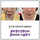 스킨365 | 압구정 피부과 더프라이드성형외과에서 콜라겐스킨부스터 올리디아 365 시술후기