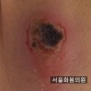 서울화봄의원 네이버블로그