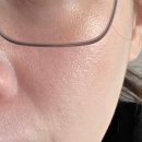 엠보보 | 리주란?쥬베룩?내 피부에 맞는 NP스킨부스터 찾기 (광고에 속지 마세요)