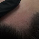 대구 두피 헤어라인 모어댄SMP 4회차 후기