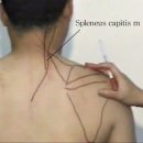 임상근육학사진3 - SCM, Splenus, Semispinalis, Levator scapula 이미지