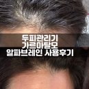 덕모상점 | 두피마사지 탈모관리기 알파브레인 앞머리 가르마 탈모 머리가 조금 채워졌어요!