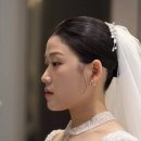 프라임성형외과의원 | 구미성형외과 티타늄리프팅 본식 2주전 후기