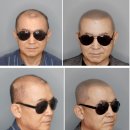 70대 삭발 두피문신 수원 닷지스칼프 후기