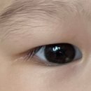아기 산동검사 눈동자 동공 하얀점 충남대병원 소아안과