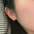 영등포봄한방병원 | 영등포 여드름 피부과 아비클리어 1회차 내돈내산 후기, 지긋지긋한 피지 고민 해결