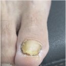 양산동작은도서관 | 광주 양산동 발톱무좀 오래 고민하다 방문한 골든풋 광주점 루씨드네일샵