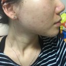 심지한의원 | 모낭염 치료 한의원 다녔던 솔직 후기