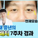 #중년 남성 눈밑지방재배치 7주차 인터뷰! 잃었던 자신감을 되찾았어요 이미지