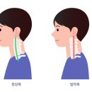 부평동 목통증 목이 뻣뻣하다면 이미 일자목증후군이 시작됐을 수 있습니다.