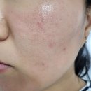 여드름흉터, 모공흉터 고민이라면? 천안 피부전문한의원 13회차 솔직후기