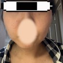 숲길신경과의원 | 영등포 편평사마귀 성지 사려니의원 내돈내산 후기, 비용 및 경과