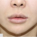 강남대로109길 45-14 | 인중축소수술후기 보면서 반드시 염두해야 할 부분