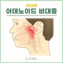 편도 아데노이드 비대증 증상, 서울아산병원 이비인후과 진료 후기