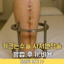 사지 | 키크는수술 사지연장술 후기 방법 가격