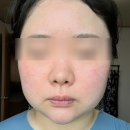 미케어 | [구미 진평동] 구미피부관리 홍조 열감 관리 선샤인미뷰티케어 에스테틱 솔직 후기