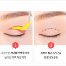 미나성형외과 네이버블로그