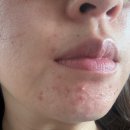 성실메디칼 | [PCOS] 9. 오바시톨 한 달 복용 후기 | 효과 본 사례가 될 지도