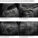 Pancreatic head carcinoma with double duct sign and dilatated gallbladder 이미지