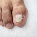 (주)하모니메디컬 | 구로발톱무좀 10년 고민 해결해 준 포쉬네일 동성제약 풀리메디 금천점