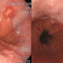 역류성 식도염이란? 이미지