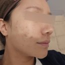 비아프의원 네이버블로그
