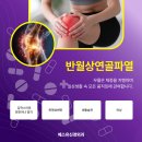 연골 | 반월상연골파열후기 통증 치료 만족하려면? [세류동정형외과]