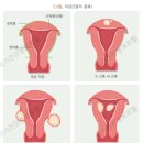 윤혜정산부인과의원 | 자궁경부암검사/질초음파 후기/ 물혹 자궁근종 / 윤혜정산부인과