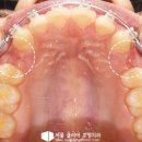 서울클리어치과교정과치과의원 | 심한 돌출입 갈현동 교정 치과 치료 과정에서 필수로 여기는 사항들과 치료기간