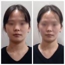 [수원 인계동 웨딩관리] 에스떼스파 수원점에서 비대칭 관리부터, 윤곽 관리 후기