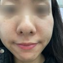 메디컬오한의원 | [시술] 메디컬오한의원 송도점 모공리액터 20회차 내돈내산 후기