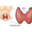 칼슘부족 저칼슘혈증 원인 (근육경련, 부갑상선, 신생아) 이미지