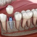 임플란트 관련주 어르신들 임플란트 시술비 지원 등 주목!! (디오, 오스템임플란트, 덴티스, 레이, 바텍, 현대바이오랜드 등) 이미지