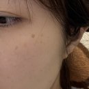 제일레이저(주) | 예젤의원 이상욱 원장님 흑자 제거 그리고 리터치 후기 (리팟레이저)