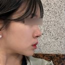 멍머리 | 홍대피부과추천 인모드 fx+fm멍 효과 솔직후기