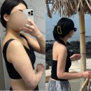 멍머리 | 팔뚝살지흡 18주차 후기, 부평지방흡입 병원으로 뼈팔 성공! + 붓기, 멍