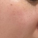 루비 | 루비레이저 후기 :: 부작용, 딱지 관리, 가격까지