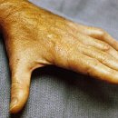 척골신경포착 증후군(Cubital tunnel syndrome) 이미지