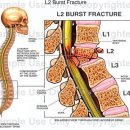 방출성 골절 (L2 Burst Fracture) 이미지