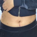 쪽땡 | 췌장 점액성 낭종&amp;담석증 수술 Q&amp;A(수술 후 2달)