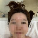 더마 리바이브 | 인천 송도 에스테틱 합법 레이저 엑스터 더마리바이브 관리 후기