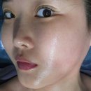 알포유베스트 | 천안 피부관리 불당동 스토리에스테틱 이중턱 탄력 관리에 탁월한 Co2 카복시 관리 후기