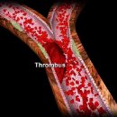 thrombus 이미지