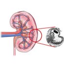 알포트 증후군[Alports syndrome소아청소년질환, 신장비뇨기질환, 유전질환] 이미지