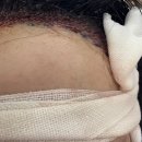움찬의원 헤어라인 모발이식 후기