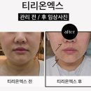 엑스세븐 | [학동/청담] 엘바이세븐 티리온엑스 피부관리 후기(티리온vs온다 차이)