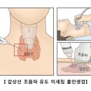 갑상선 수질암 이미지