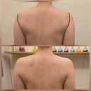 웰빙메디컬빌딩 | 승모근 뭉친 날, 뱀부테라피로 푼 이야기