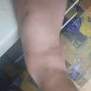 부평힘찬 | 부평힘찬병원: 발목 수술 입원부터 현재까지 이야기